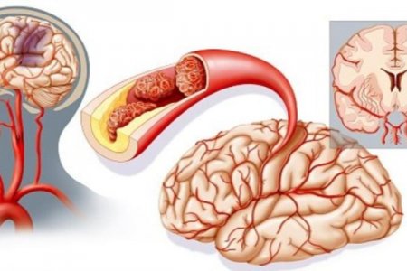 İnsultun 15 əlaməti - Həyatınızı belə xilas edin